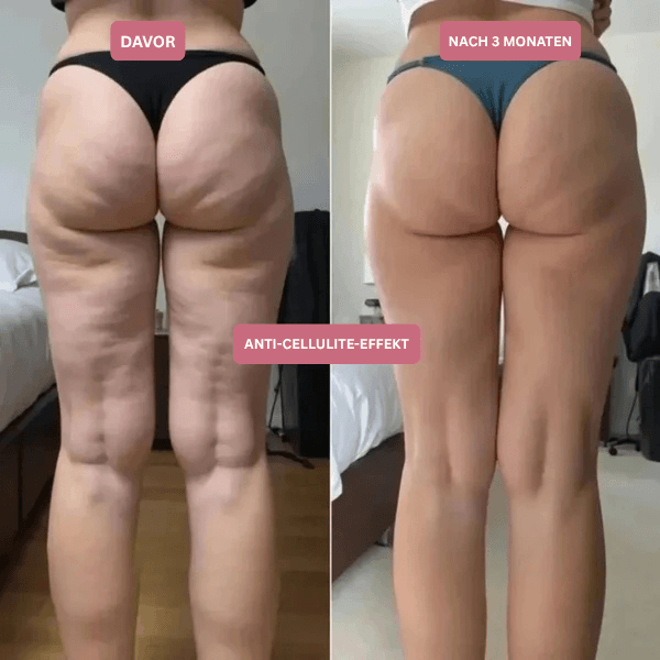 3D Anti-Cellulite-Kompressionsleggings