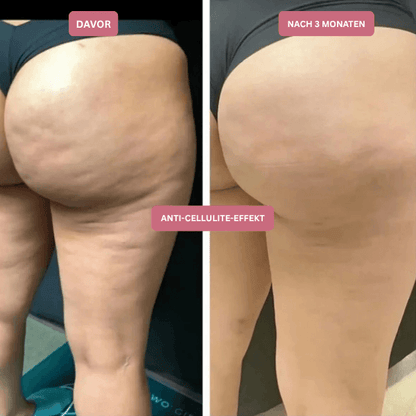 3D Anti-Cellulite-Kompressionsleggings